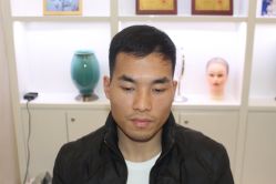 -大麦微针植发丨全国连锁