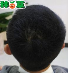 -大麦微针植发丨全国连锁