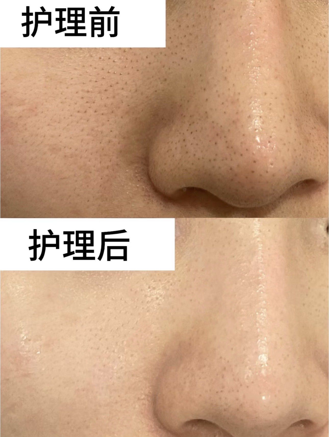 黑头深层清洁对比图