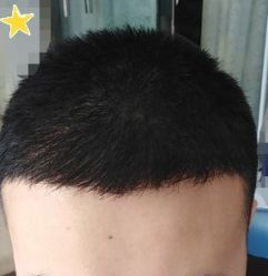 -大麦微针植发丨全国连锁