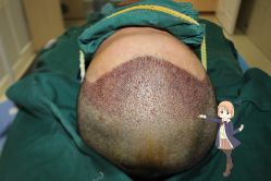 -大麦微针植发丨全国连锁