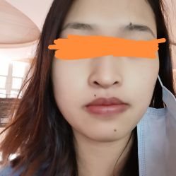 体验后-素美医疗美容·西南眼鼻整形·修复基地
