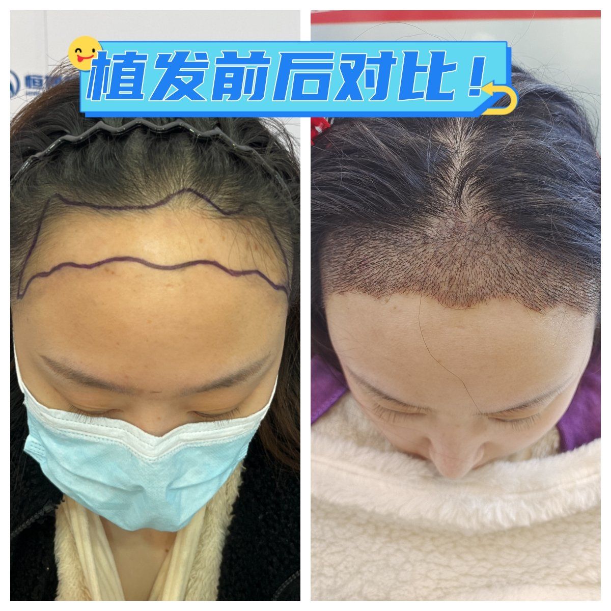 植发前后对比!