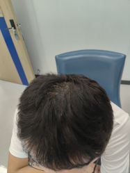 -大麦微针植发全国连锁