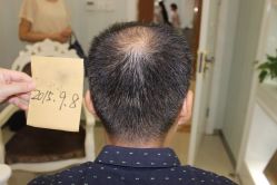 -大麦微针植发丨全国连锁