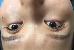 -爱莎扁平疣·汗管瘤·斑痣中心