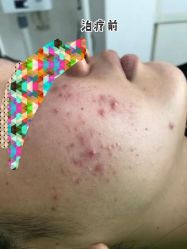 -苗医生草本科技祛痘