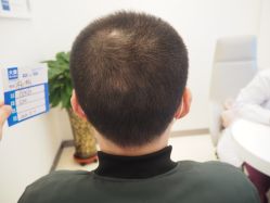 -大麦微针植发丨全国连锁