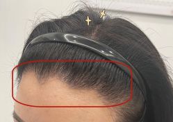 -大麦微针植发全国连锁