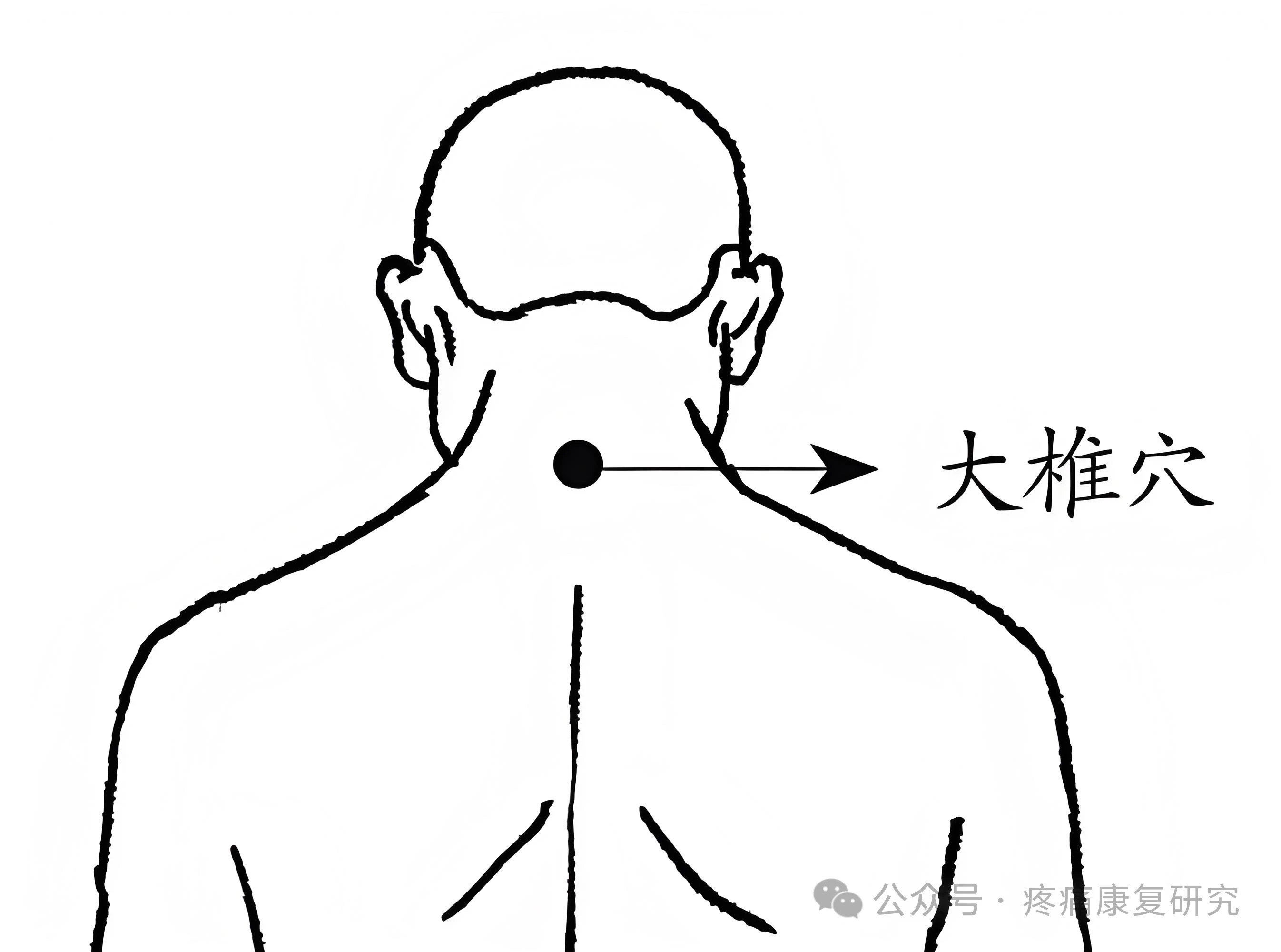 颈后"富贵包"的形成