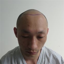 -碧莲盛·不剃发植发