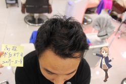 -大麦微针植发丨全国连锁