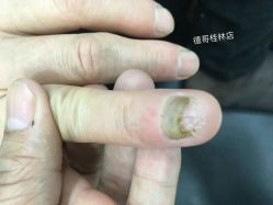 -德哥灰指甲脚气甲沟炎跖疣护理