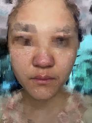 体验后-DR REBORN医疗美容