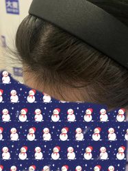 -大麦微针植发丨全国连锁