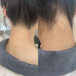 -薇兰专业脱毛连锁机构