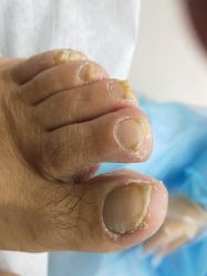 -派恩宜灰指甲鸡眼嵌甲手足癣