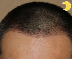 -大麦微针植发丨全国连锁