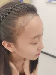 -大麦微针植发全国连锁