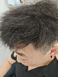 -大麦微针植发丨全国连锁