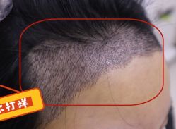 -大麦微针植发全国连锁