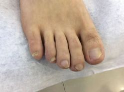 -德哥灰指甲脚气甲沟炎跖疣护理