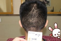 点击看大图 -大麦微针植发丨全国连锁