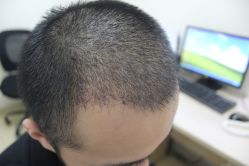 点击看大图 -大麦微针植发丨全国连锁