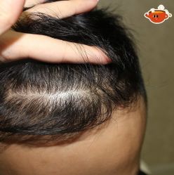 -大麦微针植发丨全国连锁