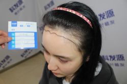 -大麦微针植发丨全国连锁