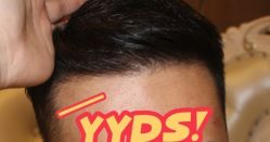 -大麦微针植发丨全国连锁