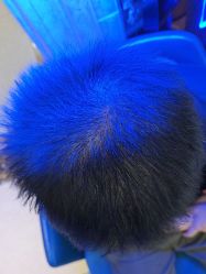 -碧莲盛·不剃发植发