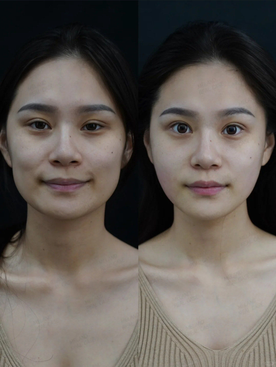 面中凹陷,苹果肌下移,现在连口角囊袋都出现了❗整个人瞬间老了十岁