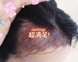 -大麦微针植发全国连锁