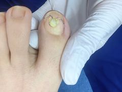 -Andrew指甲专科灰指甲·甲沟炎矫正·3D步态矫形鞋垫定制(上海法华镇路旗舰店)