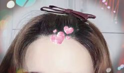 -大麦微针植发全国连锁