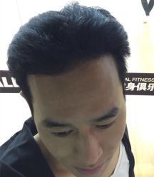 -碧莲盛·不剃发植发