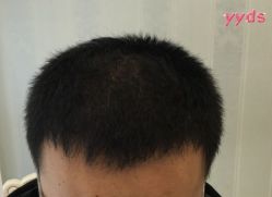 -大麦微针植发丨全国连锁