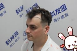 点击看大图 -大麦微针植发丨全国连锁