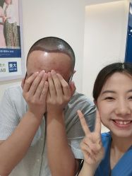 -大麦微针植发全国连锁