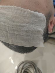 -碧莲盛·不剃发植发