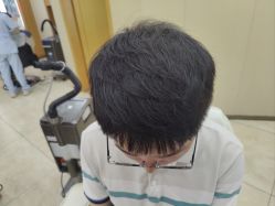 体验后-大麦微针植发全国连锁