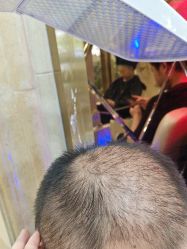 -碧莲盛·不剃发植发