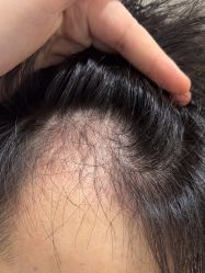 点击看大图 -碧莲盛·不剃发植发