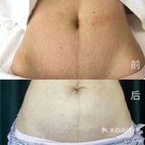 祛妊娠纹案例分享