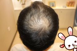 -大麦微针植发丨全国连锁