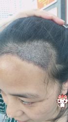 -大麦微针植发丨全国连锁