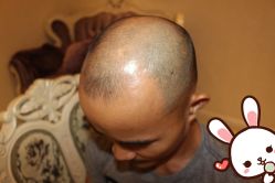 点击看大图 -大麦微针植发丨全国连锁