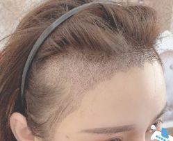 -大麦微针植发丨全国连锁