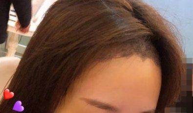 -大麦微针植发丨全国连锁